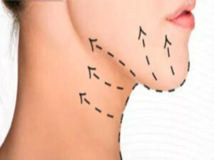 Dra. Gisele Araujo papada